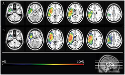 Communicative-Pragmatic Assessment Is Sensitive and Time-Effective in Measuring the Outcome of Aphasia Therapy